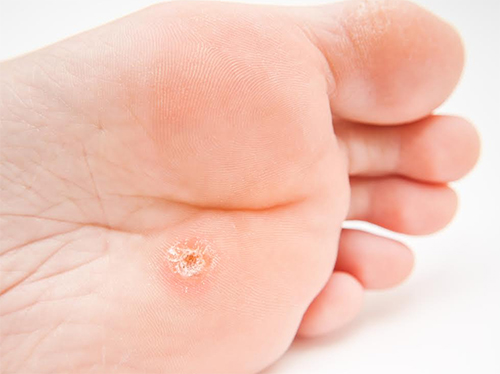 Picture of a plantar wart before treatment.